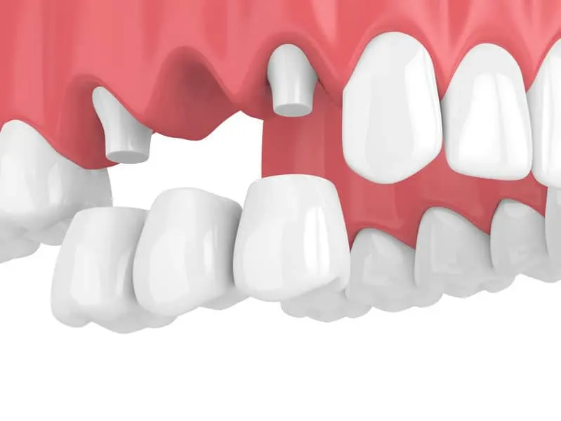 Mosty protetyczne Warszawa Bemowo